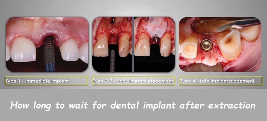 How long to wait for dental implant after extraction