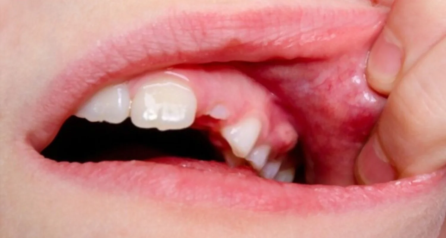 how to drain a gum abscess at home