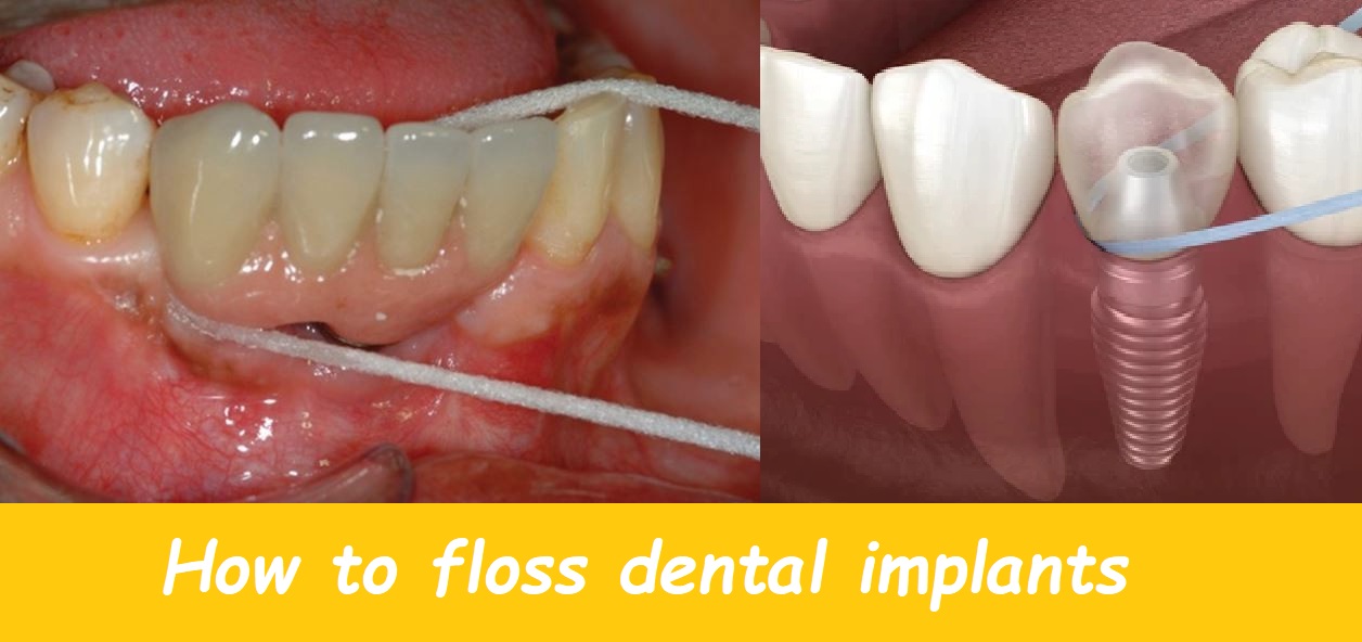 How to floss dental implants