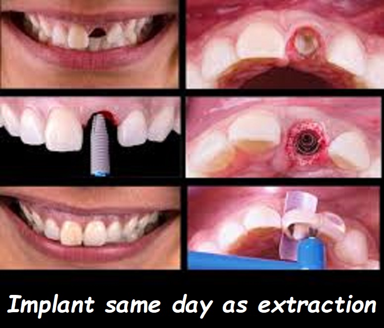 Implant same day as extraction