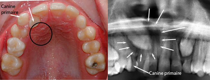 Ingrown canine tooth