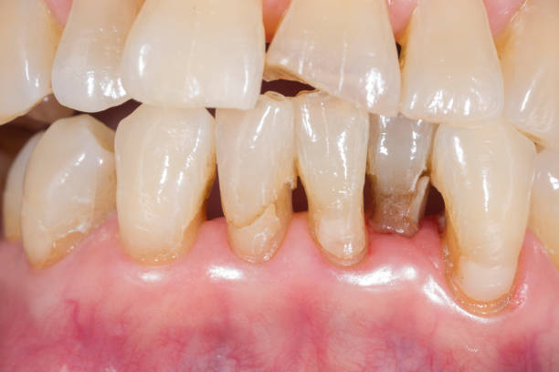 Loose teeth with moderate mobility