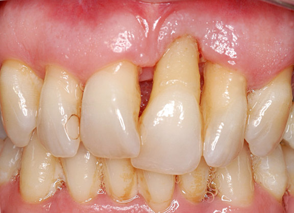 Loose tooth with severe bone loss due to periodontal disease