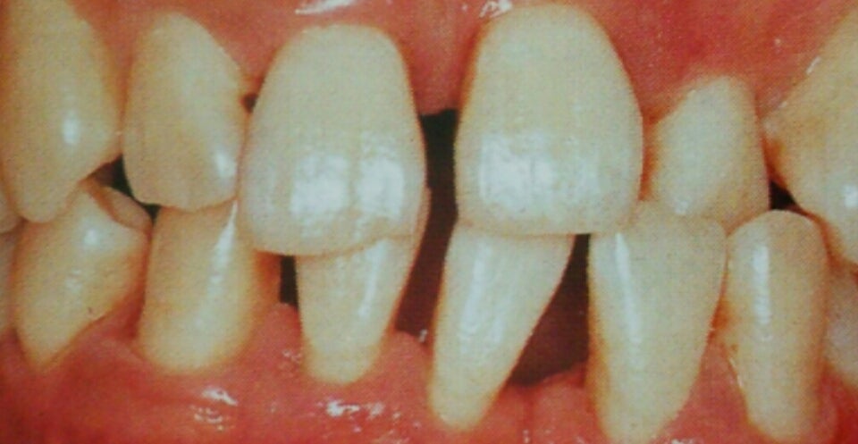 Loose tooth with slight mobility due to bone loss