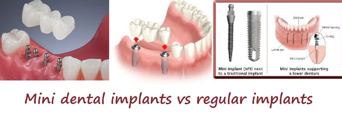 Mini dental implants vs regular implants