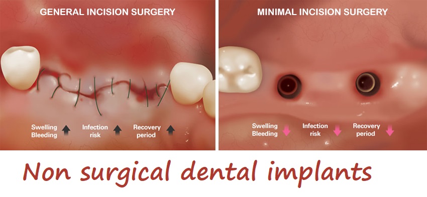 Non surgical dental implants