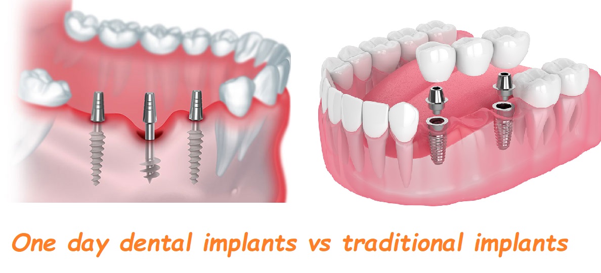 one day dental implants vs traditional implants