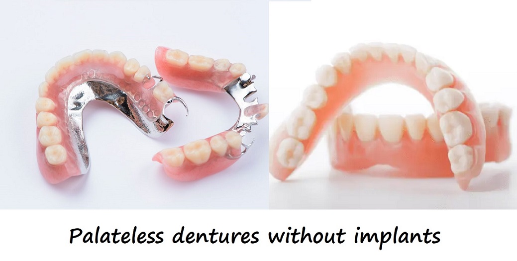 Palateless dentures without implants