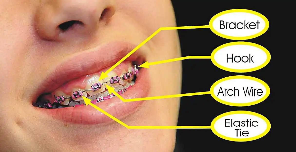 parts of braces