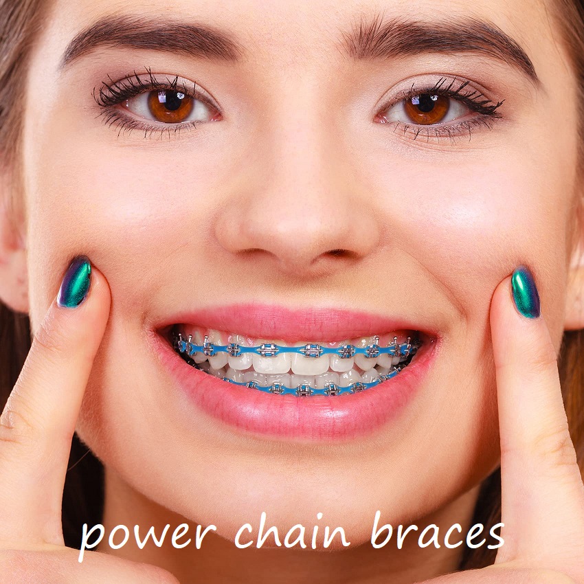 power chain braces