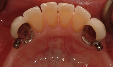 precision attachment partial denture