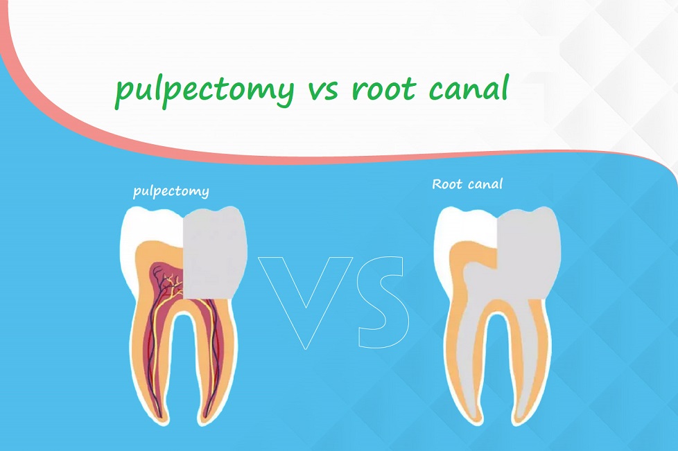 pulpectomy vs root canal