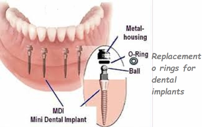 Replacement o rings for dental implants