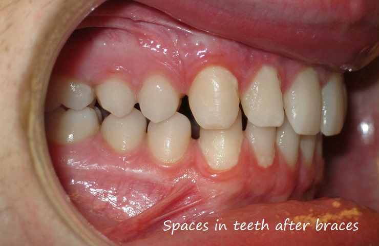 Spaces in teeth after braces