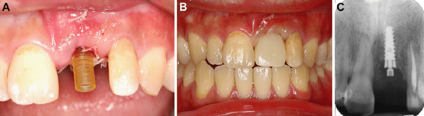 Temporary dental implants