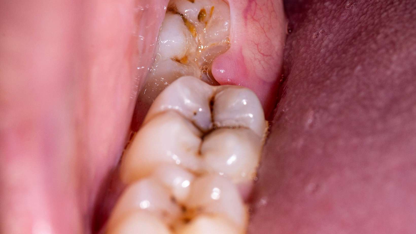 The coming in of wisdom tooth often cause infection of nearby area showing symptoms of pain in ear