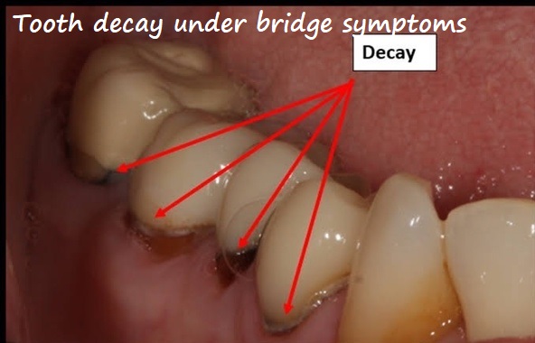 Tooth decay under bridge symptoms