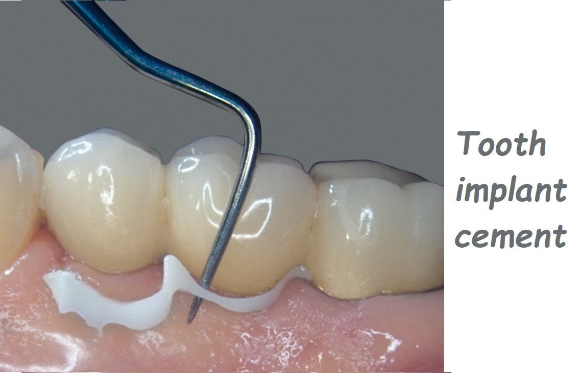 Tooth implant cement