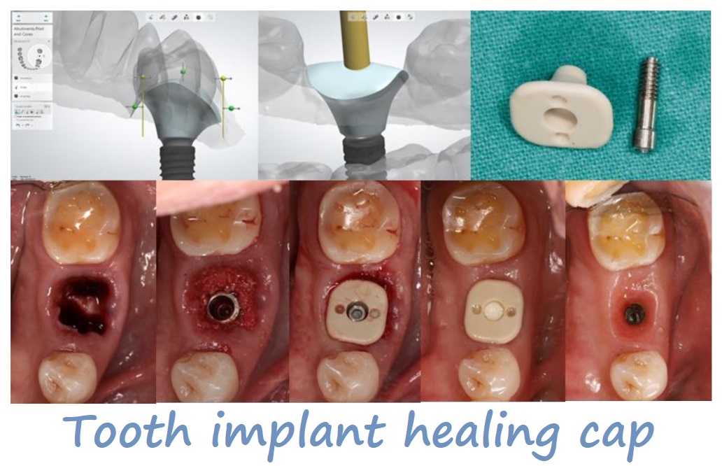 Tooth implant healing cap