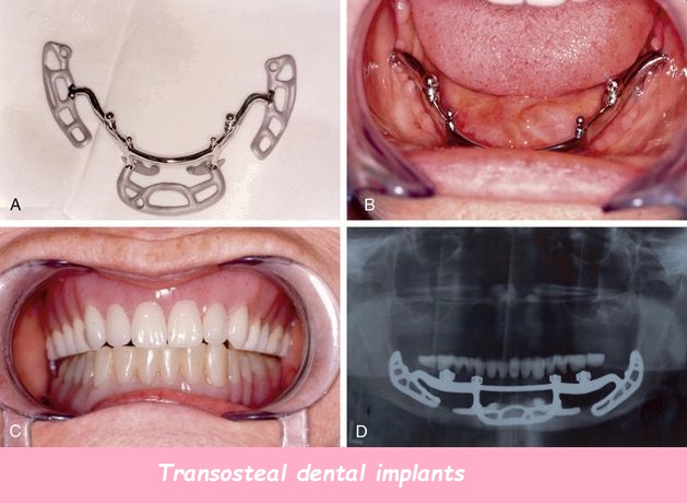 Transosteal dental implants