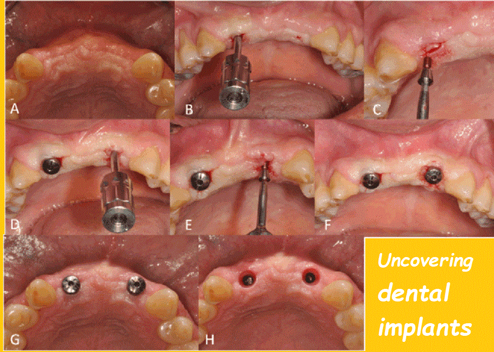 Uncovering dental implants