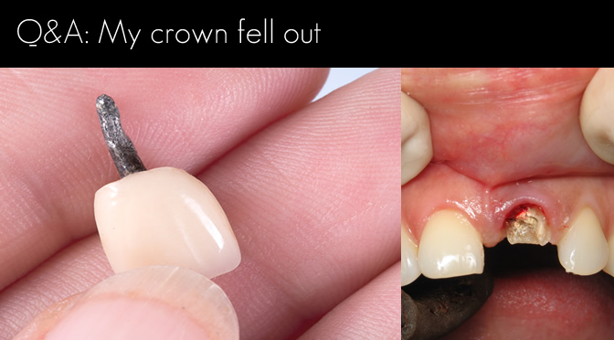 root canal crown fell off