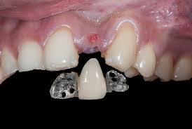 Front Tooth Maryland Bridge Dental