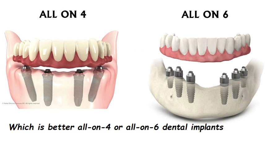 Which is better all-on-4 or all-on-6 dental implants