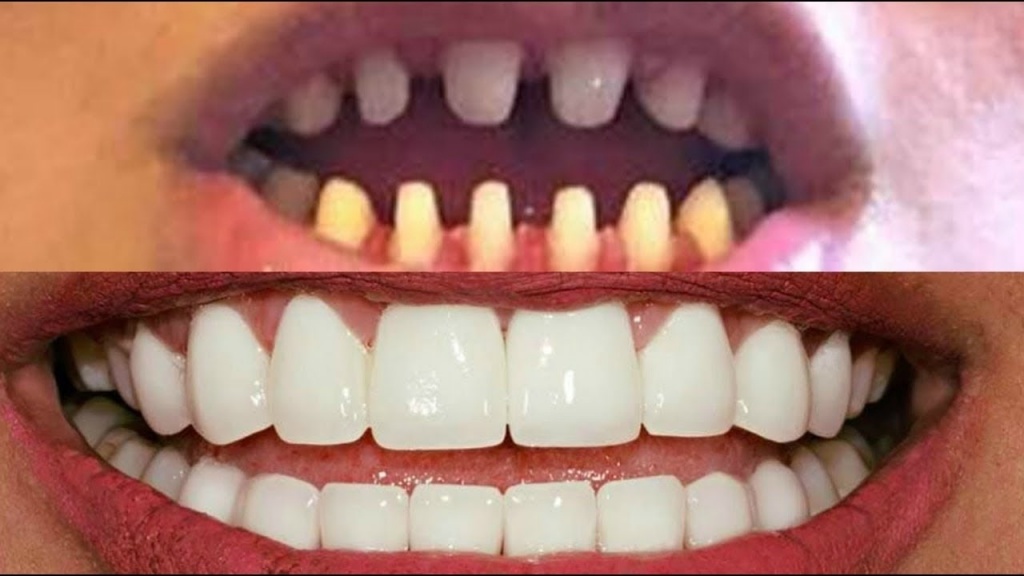 Zirconia Crowns for front teeth