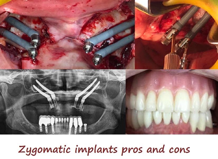 Zygomatic implants pros and cons