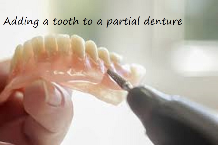 adding a tooth to a partial denture