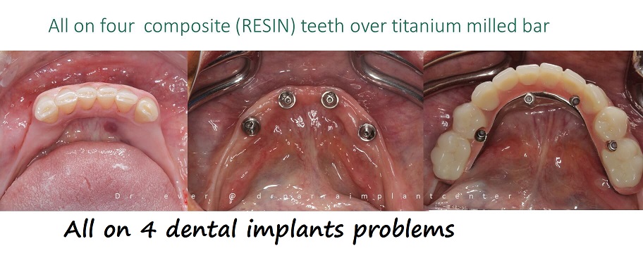 all on 4 dental implants problems