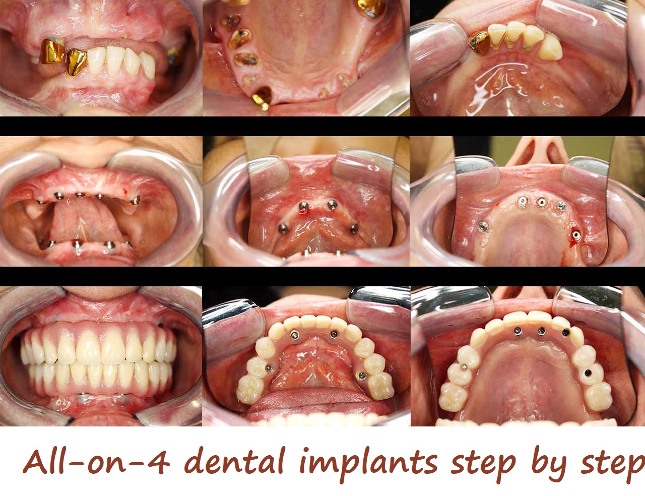 All-on-4 dental implants procedure steps