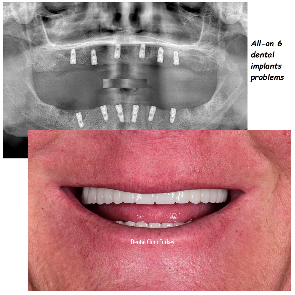 All-on 6 dental implants problems