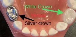 alternative to silver caps on toddler teeth