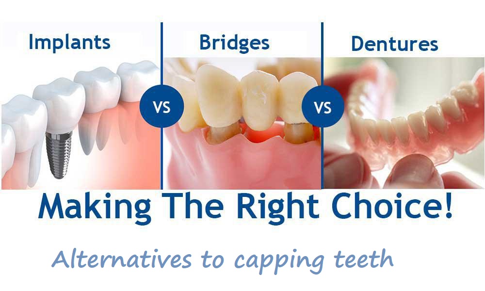 alternatives to capping teeth