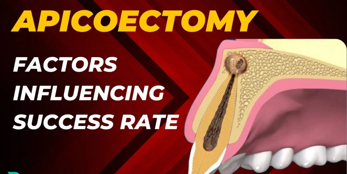 apicoectomy success rate