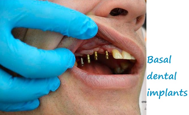 Basal dental implants