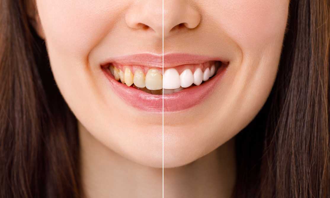 best teeth whitening