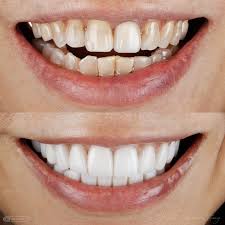 best teeth whitening