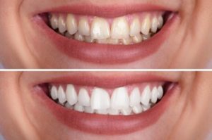 best teeth whitening