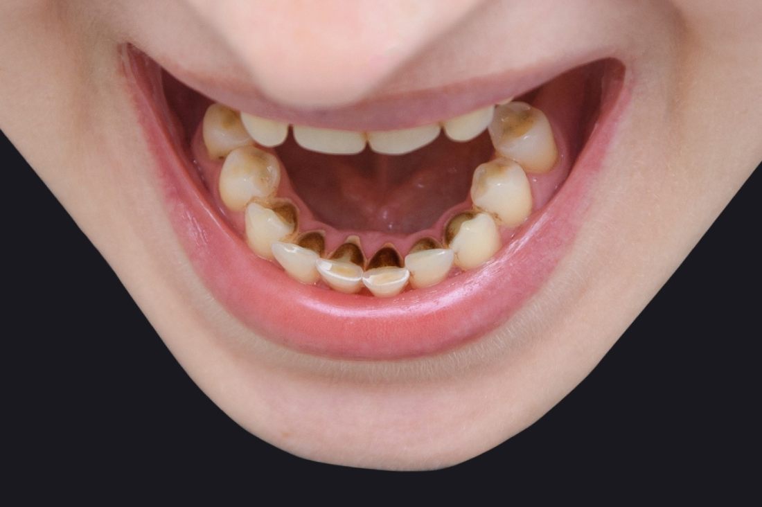 black tartar on teeth