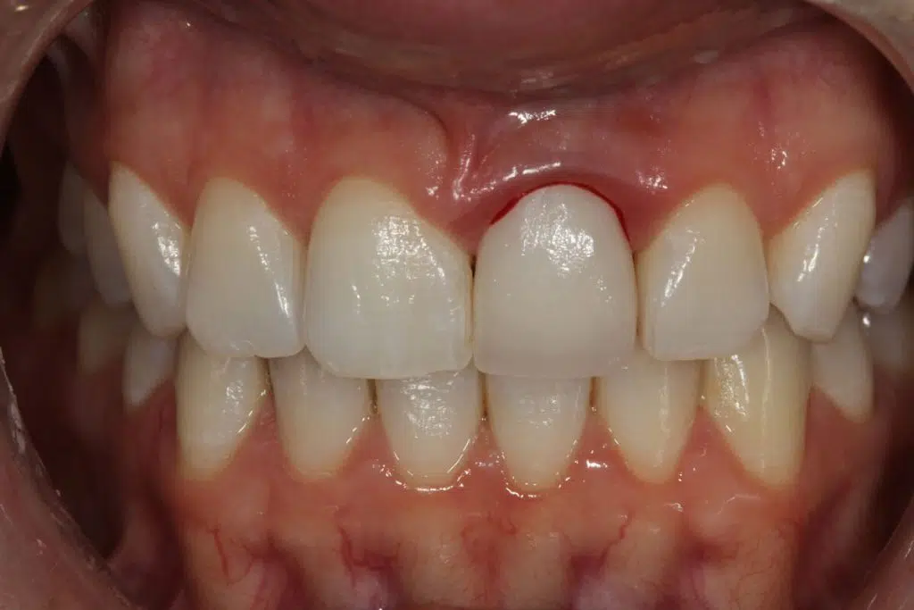 bleeding crown tooth