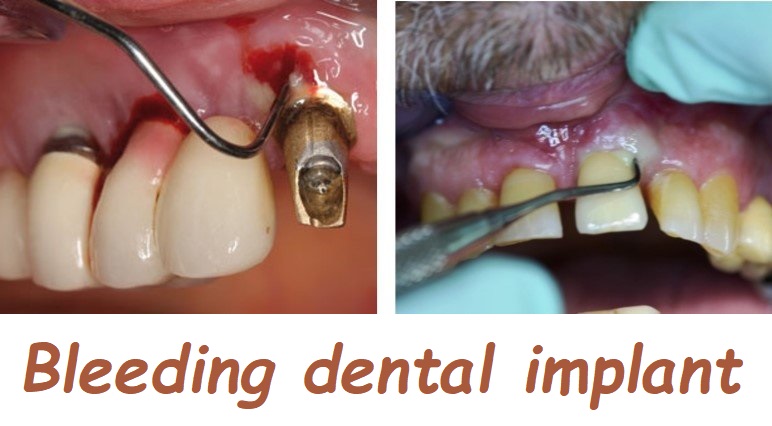 Bleeding dental implant