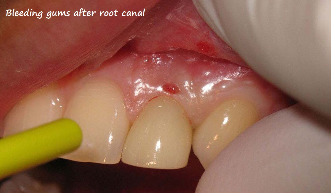 bleeding gums after root canal