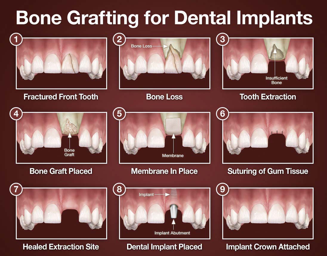 bone graft implant timeline