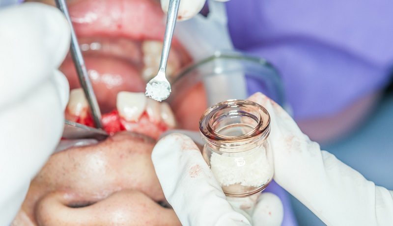 bone grafting in teeth