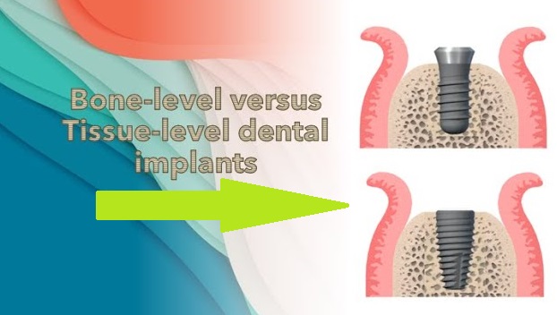 Bone level vs tissue level implant