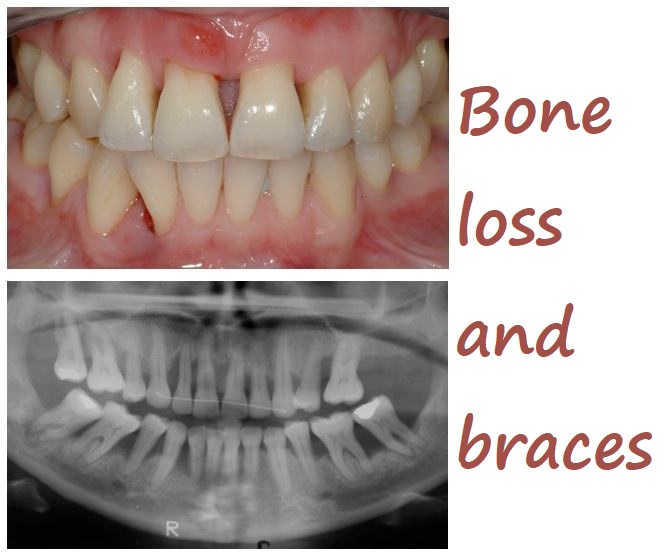 Bone Loss and Braces Understanding the Connection and Managing Oral Health