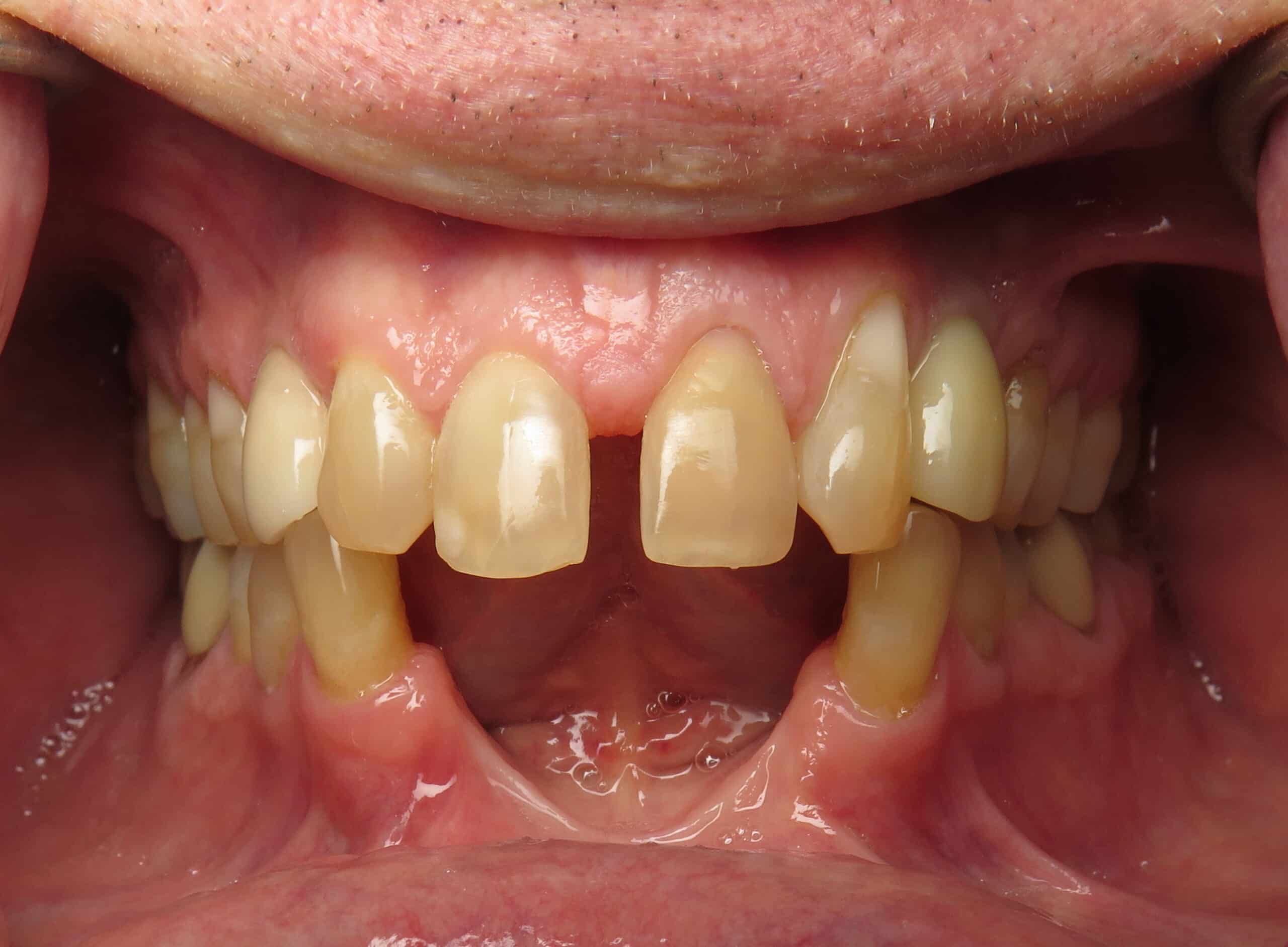 bone loss in teeth